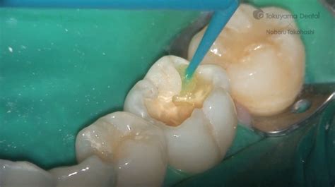 Posterior tooth direct restoration with resin composite – DentalmedTV