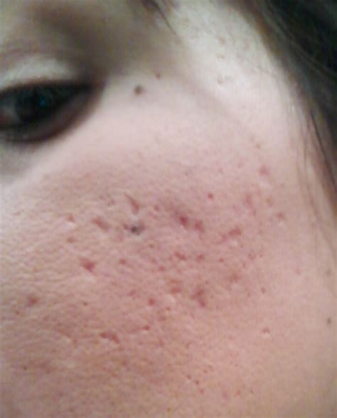 Tca Cross Nose Before And After