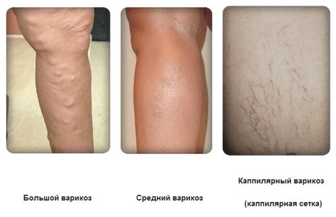 Первая стадия варикоза фото