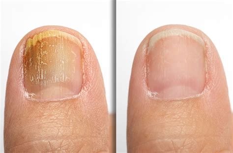 nail fungus advance foot clinic podiatry
