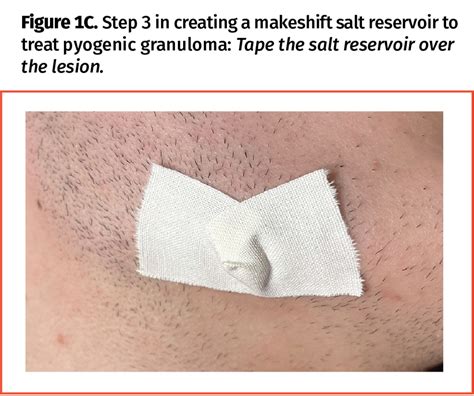 umbilical pyogenic granuloma  case   reddish umbilical tumor