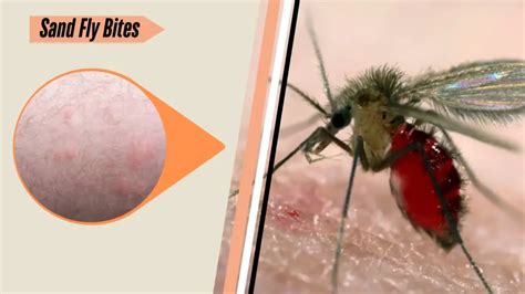 types  insect bites identification  picture