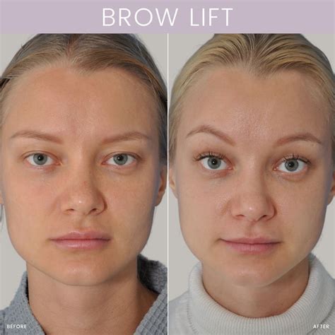 Brow lift before and after – Artofit