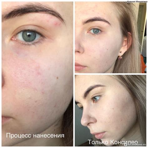 Как замаскировать прыщи на лице с помощью косметики и без неё