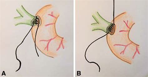 continuous  interrupted suture technique  hepaticojejunostomy