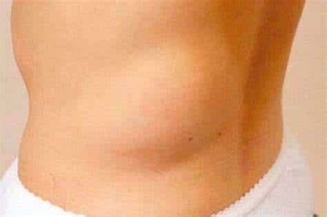 lipoma en tercera edad, lipoma, lipoma adulto mayor