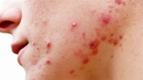 Acne vaccine? UC San Diego researchers says they’re vaccine is ...