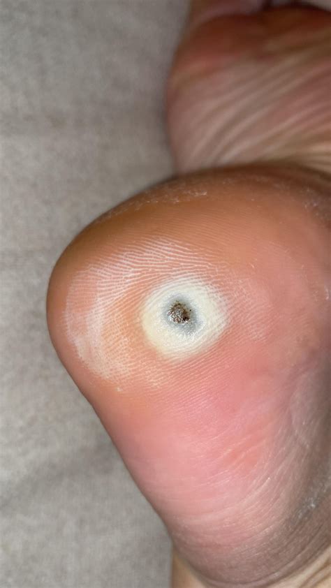 Wart turning black, showing dermal tissue after debriding. Happened