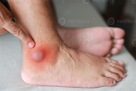 A man injured his ankle and it was swollen and red. Causes of pain