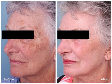 laser skin resurfacing derm artisan