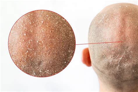 11 Itchy Scalp Treatments You Should Know | Svenson