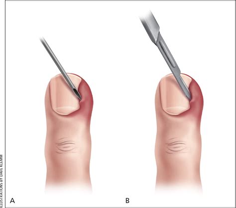 paronychia vs ingrown nail - theocon