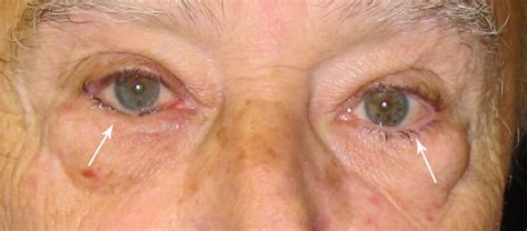 Entropion | Solve the problem Oculoplastica | Dr Graziani