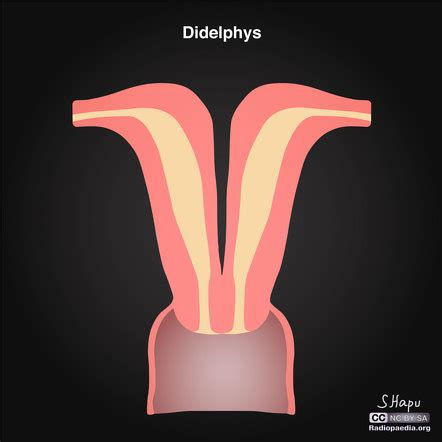 Uterus didelphys | Radiology Reference Article | Radiopaedia.org