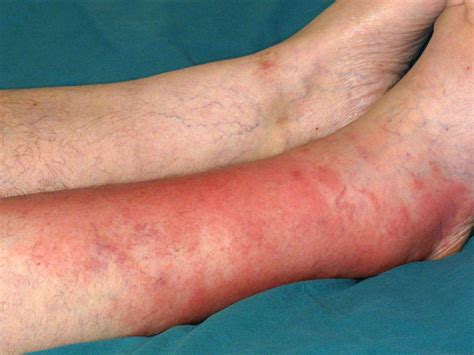 cellulitis foot