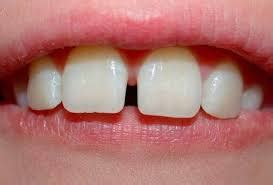 Dente Separado No Meio - Dente separado - Principais causas, risco para a saúde e tratamentos