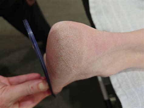 Heel Pain Treatment | Sydney Sports Podiatry