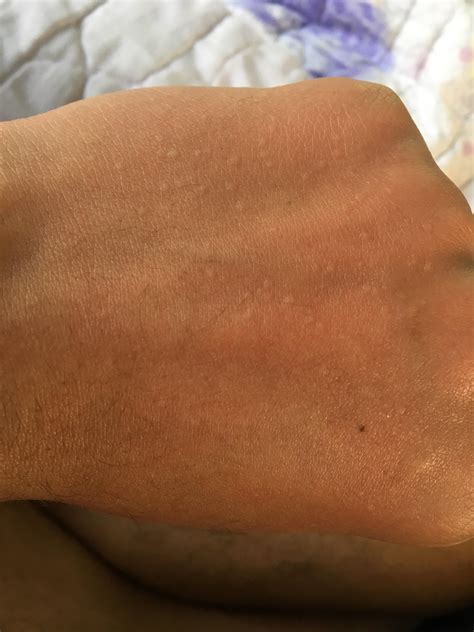 Cholinergic Urticaria Face