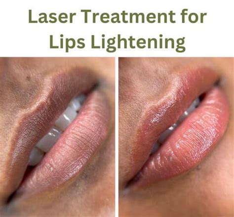 Laser Treatment for Lips Lightening – Skin Hair and Pain Treatment