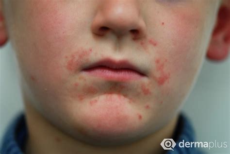 Mundrose (Periorale Dermatitis) - Ursachen & Therapie | derma.plus