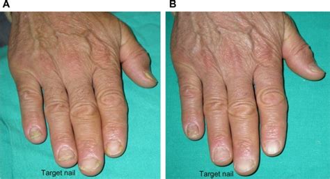 Onycholysis and leukonychia completely resolved, and improvement of ...