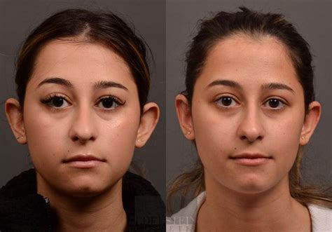 ear surgery     dr jerome edelstein toronto