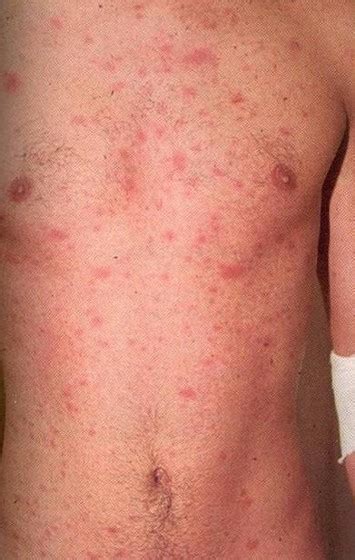 Hiv Symptoms Rash - Infoupdate.org