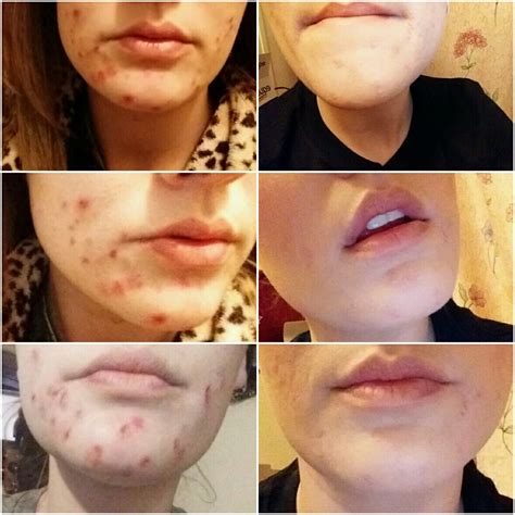 week  differin gel differin gel diy beauty gel