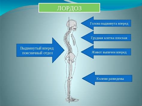 Лордоз - что это такое, виды лордоза, причины, симптомы, диагностика ...
