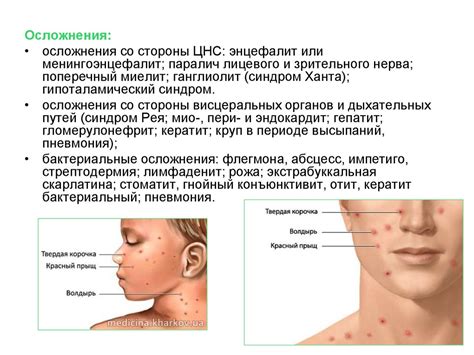 Ветряная оспа - презентация онлайн