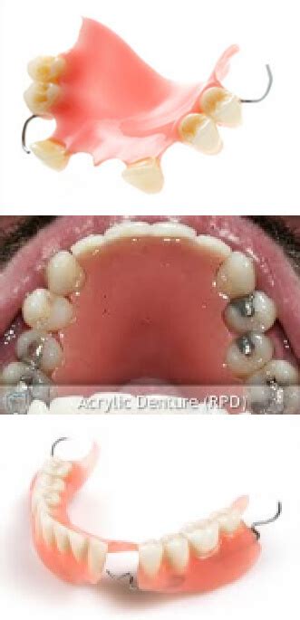 Partial Acrylic Dentures - Bytes Dental Ballina Goonellabah Lismore