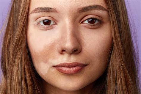 Бели петна по кожата – причини и лечение | For Life