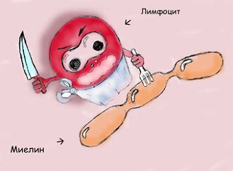 Рассеянный склероз: симптомы, причины, лечение