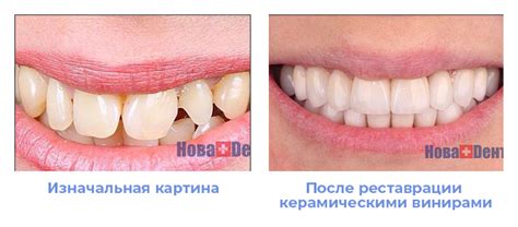 Реставрация зубов и восстановление: фото, цены в Москве | НоваДент, Москва