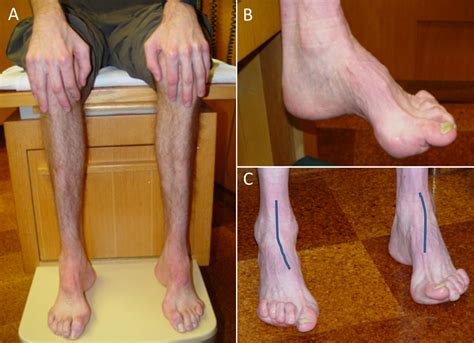 Charcot-Marie-Tooth Disease and Other Hereditary Neuropathie ...