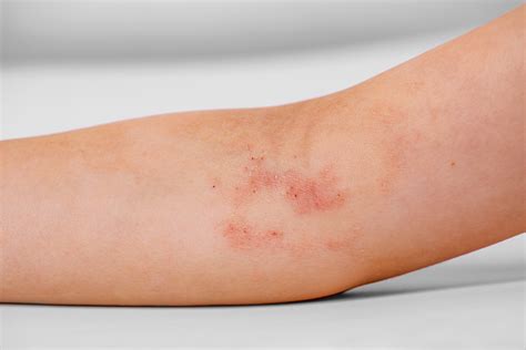 Mild Atopic Dermatitis