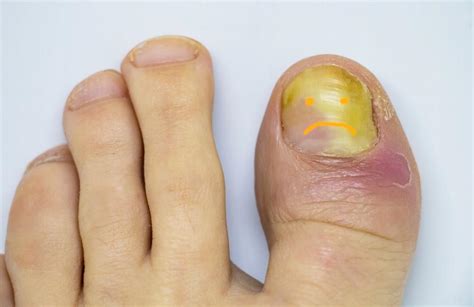 Diabetic Toenails Treatment: Top 11 Options & More Tips