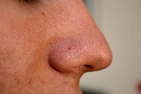 Youtube Blackheads Removal - Stories