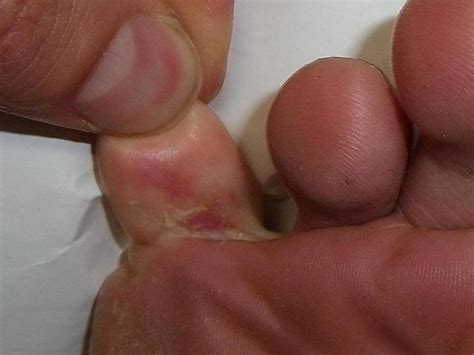 How to Cure Athlete's Foot Between Toes and Toenail Fungus - HubPages