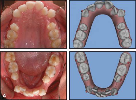 premolar extraction  adult  aligners