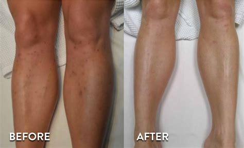 Laser Hair Removal Before and After Pictures | Atlanta, GA