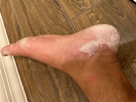 White spots on feet when wet : r/DermatologyQuestions