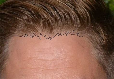 Characteristics of a Natural Hairline - Receding hairline-Dr Bonaros