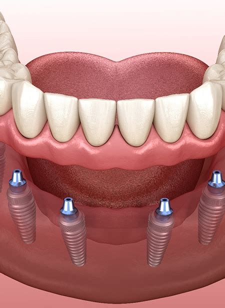 Implant Dentures in Manchester | Tooth Loss | Webster Dental Associates ...