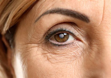 What Causes a Cataract? | Ophthalmologist Guide