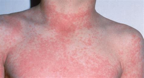 Scarlet fever | BabyCenter