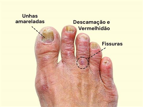 Doenças De Pele Causada Por Fungo - Esporos De Fungos Na Pele Fungos E O Seu Impacto Para A Nossa Saúde