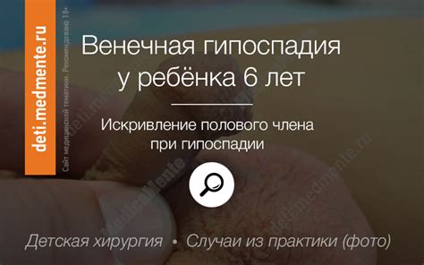 Гипоспадия у детей: фото до и после | Никитский М.Н.