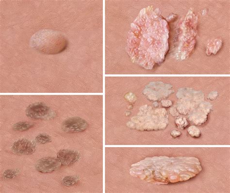 Genital Skin Warts