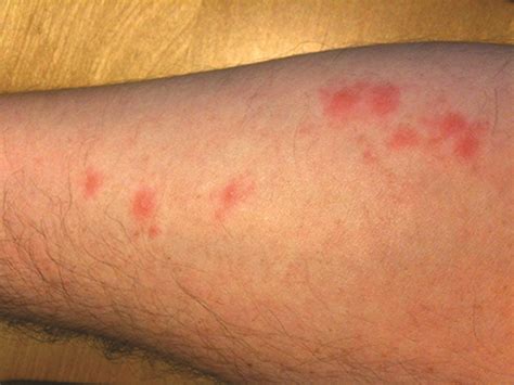 Bed Bug Bites, Rashes & Symptoms